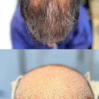 فول تراکم ترین کاشت مو شیراز با روش SMFIT|خدمات زیبایی و سلامت|شیراز, زرگری|دیوار