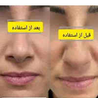 کرم سفید کننده صورت وبدن 10درجه سفیدی بدون بازگشت|آرایشی، بهداشتی، درمانی|کرمان, |دیوار