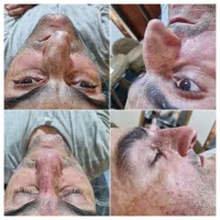 اصلاح فرم بینی بدون جراحی قیمت استثنایی