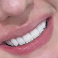 مدت محدود آموزش کامپوزیت دندان لیرینگ لب شیشه‌ای|خدمات آرایشگری و زیبایی|کرج, چهارصد دستگاه|دیوار