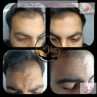 تزریق ژل،بوتاکس،آنزیم،پی آر پی، مزو ژل برای آقایان|خدمات آرایشگری و زیبایی|خرمشهر, |دیوار