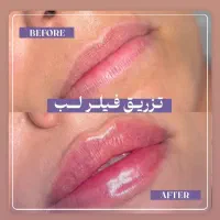 فیلر لب ۱/۶۰۰/تاپایان این هفته|خدمات آرایشگری و زیبایی|رشت, کوی حسینی|دیوار