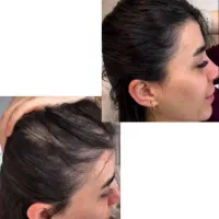 با ریزش موهات خداحافظی کن