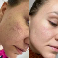 لیزرco2ترکیبی تک جلسه ای هموارساز اف ویژه|خدمات آرایشگری و زیبایی|دوگنبدان, |دیوار