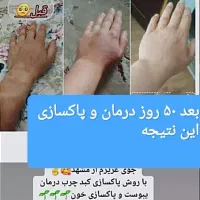 درمان اگزما و پسوریازیس خودایمنی