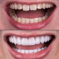 دوره های بلندمدت کامل دندانپزشکی کامپوزیت و لمینیت