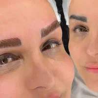 میکرو ،روشن سازی تتو قدیمی تیره ژل و بوتاکس بیرجند