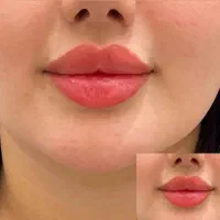 تزریق چربی،ژل،بوتاکس ونخ و مادلینگ تخصصی توسط پزشک