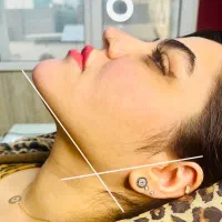 ساکشن غبغب و بلفاگربه ای قیمت عالی-پزشک عالی