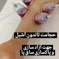 آموزش دوره تخصصی حجامت فصد زالو بادکش