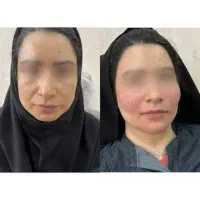 آموزش تخصصی و درمانی ژل و بوتاکس|خدمات آموزشی|اصفهان, مهدی آباد|دیوار