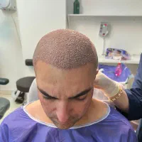 جشنواره کاشت تخصصی موفقط 8/900با ضمانت|خدمات آرایشگری و زیبایی|تهران, پاسداران|دیوار