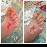 درمان زخم دیابت و زخم بستر سوختگی و عفونی|خدمات آرایشگری و زیبایی|کرج, باغستان|دیوار