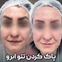 ریموو انواع تتو و خالکوبی بدون هیچ اثری توسط پزشک