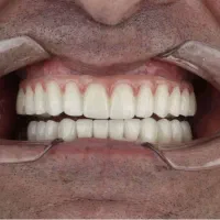 دندانپزشکی اوردنچر دو فک ۱۸۵ تومن در تبریز