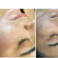 تکنیک پوست کره‌ای، میکرونیدلینگ، مزو مو و ابرو