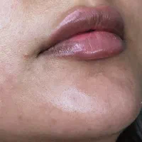 ژل و بوتاکس|خدمات آرایشگری و زیبایی|قاسم‌آباد (خواف), |دیوار