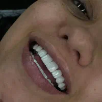 کامپوزیت دندان روکش سرامیکی ایمپلنت لمینت اقساطی|خدمات آرایشگری و زیبایی|تهران, صادقیه|دیوار