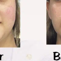 مدل فیلر صورت در کلینیک نوا|خدمات آرایشگری و زیبایی|شیراز, ستارخان|دیوار