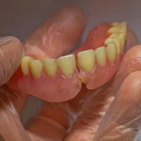 تعمییر شکستگی دندان مصنوعی اضاف کردن دندان