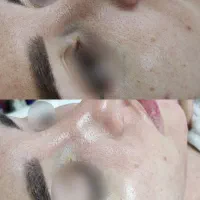 زیبایی صورتت با ما /مزونیدلینگ و PRP صورت