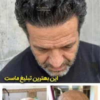 کاشت مو سوپر نچرال بدون جراحی|خدمات زیبایی و سلامت|شیراز, ستارخان|دیوار