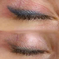 ریموو تاتو صورت و بدن با لیزر کیوسوییچ امریکایی|خدمات آرایشگری و زیبایی|گرگان, |دیوار