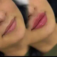 بوتاکس ۸۵۰مصپورت و ژل ۱۸۰۰ توست پزشک انجام میشه|خدمات آرایشگری و زیبایی|مشهد, محمدآباد|دیوار