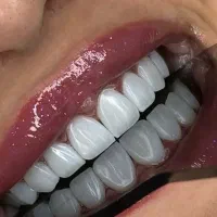 مدل کامپوزیت لیرینگ لبه شیشه ای