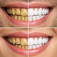 ویولمیتKK00