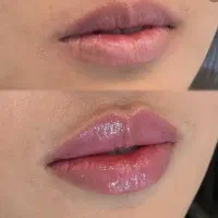 تخفیف باورنکردنی ۵۰٪ ژل لب توسط پزشک فقط۳ روز