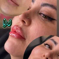 تزریق ژل و بوتاکس تضمینی (کلنیک ایرانا)|خدمات آرایشگری و زیبایی|یاسوج, |دیوار