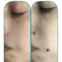 برداشتن خال۱۰ هزار تومن دریک جلسه،فیلر۳۰۰،جوانسازی