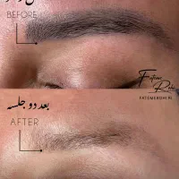 جذب مدل ریموو تتو صورت به مدت محدود