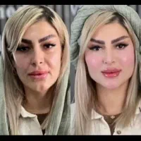 فیلر و بوتاکس ۵۰درصد تخفیف ولنتاین اموزش رایگان