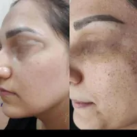 خدمات حرفه ای تخصصی،لک کک مک موی زائدسفیدالکترولیز|خدمات آرایشگری و زیبایی|قم, صفائیه|دیوار