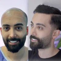 کاشت مو و ابرو