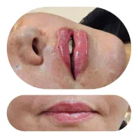 بوتاکس ژلPRP مزو لیزر هایفو بلفاروپلاستی لیپوساکشن