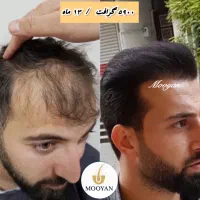 کاشت مو فقط با ۲۱و کاشت ابرو با ۱۴ تومان