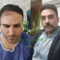 کاشت مو و ابرو ، نقد و اقساط