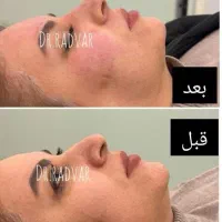 فیلربینی ژل لب فیلرزیرچشم زاویه بوتاکس تعریق میگرن