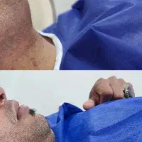 بلفاروپلاستی ساکشن غبغب|خدمات آرایشگری و زیبایی|اصفهان, مهدی آباد|دیوار