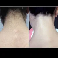 لیزر موهای زائدبدن باقیمت باورنکردنی به مدت محدود|خدمات زیبایی و سلامت|اهواز, پردیس دو|دیوار