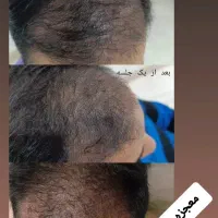 جشنواره مزوتراپی وبوتاکس به مناسبت افتتاح مطب پزشک|خدمات آرایشگری و زیبایی|قم, بکایی|دیوار