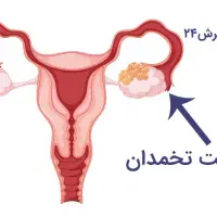 درمان قطعی نازایی.کیست تخمدان.