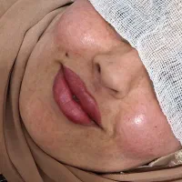 ژل فیلر بوتاکس مزو PRP و پرسینگ