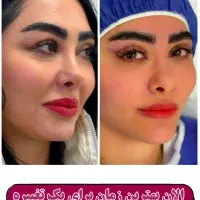 بلفاروپلاستی توسط متخصص چشم با بخیه سوپرنانو لیزری|خدمات آرایشگری و زیبایی|تهران, جردن|دیوار