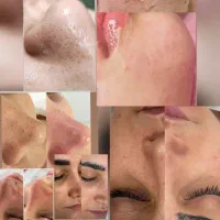 فیشال /پاکسازی/زیبایی/پوست