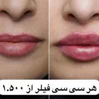 هایفو، فیلر، بوتاکس|خدمات آرایشگری و زیبایی|تهران, جیحون|دیوار