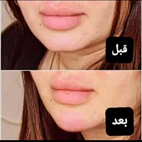 نیازمند مدل بوتاکس و ژل.اموزش ژل و بوتاکس|خدمات آرایشگری و زیبایی|صدرا-فارس, فاز ۱|دیوار